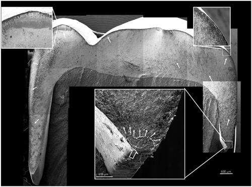Figure 5. Fractographic map of a fractured crown (3Y zirconia). The origin can be traced back to the crown margin on the mesial curvature (large open arrow). Small white arrows indicate the direction of crack propagation.