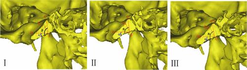 Figure 2 Schematic diagram of the angle and length measurement of different screw placement methods on children’s cranial slopes. (I) Point A of clival screw placement in the middle sagittal position of the reconstructed model. The lengths LAA, LAB, and LAC in horizontal screw placement, vertical bone screw placement, and extreme screw placement, as well as the horizontal entry angle α and the ultimate entry angle β, were used at point A. (II) The reconstructed model was 3.75 mm away from the sagittal screw placement (point B) at the left edge of the slope. At point B, the lengths of screw placement LBA1, LBB1, and LBC1 in horizontal screw placement, vertical bone screw placement, and extreme screw placement, and the horizontal entry angle α1 and the ultimate entry angle β1, respectively, were used. (III) The reconstructed model was 3.75 mm away from the right edge of the slope at sagittal screw placement point C. The length of screw placement at point C was LCA2, LCB2, LCC2 in horizontal screw placement, vertical bone screw placement, and extreme screw placement, respectively. Approach angle α2 = horizontal screw placement; approach angle β2 = extreme screw placement.