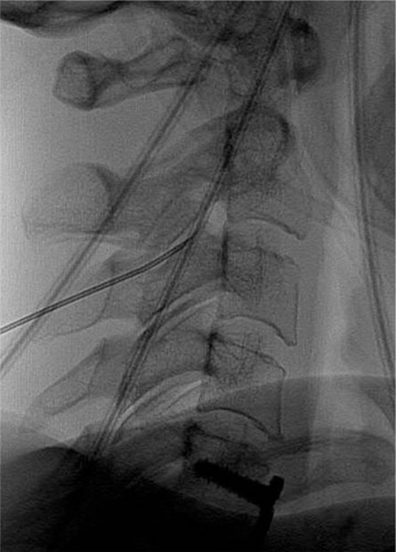 Figure 3 A lateral radiograph demonstrating the first needle placement for radio-frequency ablation of the third occipital nerve.