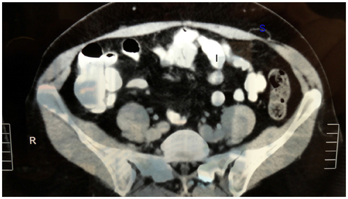 Figure 2 Computed tomography of Spiegel’s hernia.