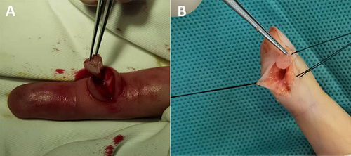Figure 2 (A and B) Intraoperative white skin nodule, 6–7 mm in size, well defined.