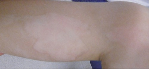 Figure 9 Results after 2 months of tested topical cream.