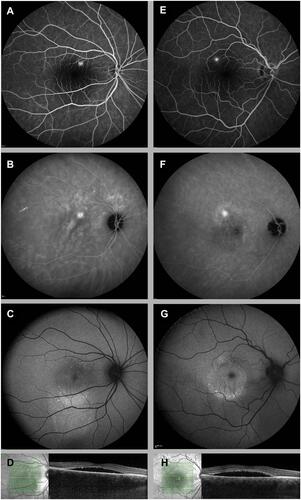 Figure 2 Clinical features visible on multimodal imaging of the right eye of a 37-year-old female patient (A–D) and a 34-year-old male patient (E–H) with aCSC. (A and E) FA revealed one focal “hot spot” of leakage and no changes in the retinal pigment epithelium. (B and F) Despite these circumscribed lesions on FA, ICGA revealed a more widespread area of hyper-fluorescence, which corresponded with multifocal (B) or monofocal (F) choroidal leakage. (C and G) FAF imaging revealed speckled (ie, granular) hyper-autofluorescent changes at the site of serous neuroretinal detachment in both patients, which corresponded with serous retinal detachment visualized on OCT (D, H).Abbreviations: aCSC, acute central serous chorioretinopathy; ICGA, indocyanine green angiography; FA, Fluorescein angiography; FAF, Fundus autofluorescence; OCT, optical coherence tomography; SRF, subretinal serous fluid; RPE, retinal pigment epithelium.