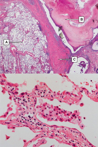 Figure 1. Upper part: overview of the right lung resectate showing (A) emphysema, (B) tumor-forming fungal growth (i.e. mycetoma) in the bronchial lumen, (C) fibrosis of the lung parenchyma (H&E, magnification × 50). Lower part: Right lung resectate showing mild interstitial lymphocytic inflammatory infiltrate; intra-alveolar aggregate of inflammatory cells including foamy macrophages (Gaucher cells) (H&E, magnification × 200).