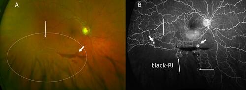Figure 3 Retinal ghost vessels and retinal microvascular anomalies. (A) An Optos color image showing a visible network of ghost vessels in the inferotemporal retina and a nearby small retinal microvascular anomaly (RMAs, long arrow) indicating an “old” branch retinal vein occlusion (BRVO). Although the patient’s vision was not affected, a pre-retinal hemorrhage with a visible retinal neovascularization (NVE, short arrow) suggested progression to late complication from a previous untreated BRVO episode. (B) The Optos ultra-widefield fluorescein angiogram (UWF-FA) of the same eye depicting the presence of black retinal ischemia (black-RI) corresponding to the location of the ghost vessels. In addition to outlining the extent of black-RI, UWF-FA is also distinguishing more NVEs (short arrows) and numerous RMAs (long arrows) along the water-shed border of black-RI in comparison to clinical or photographic detection.