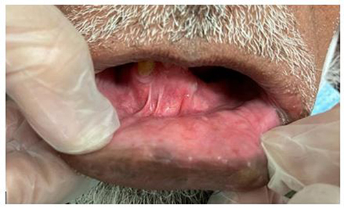 Figure 4 Clinical photograph showing complete resolution of symptoms and pigmentation after discontinuing the dye.