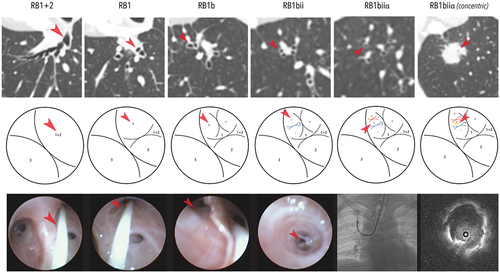 Figure 1. A lung nodule measuring 1.9 cm was located in the apical segment of the right upper lobe. The CT scan in axial reconstruction was rotated 90 degrees counter clockwise to simulate the actual bronchoscopic view (upper panel). The airway and each bifurcation leading to the target were traced and marked from the right upper lobe bronchus into the target segment of RB1biiα (middle panel) employing the manual bronchial branch tracing technique. The actual bronchoscopic view, accessed with an ultrathin bronchoscope (BF-MP190F), was shown in the lower panel with a prophylactic balloon blocker in place (lower panel). The final approach was adjusted with single-plane fluoroscopy, confirming a concentric R-EBUS lesion. Cryobiopsy confirmed lung adenocarcinoma. (Unpublished data obtained from study approved by the Medical Research & Ethics Committee, Ministry of Health Malaysia (NMRR ID-23-03628-QAG) which waived the need for individual consent for this publication.)