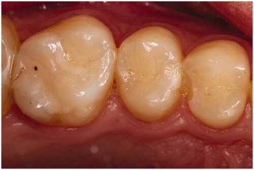 Figure 4. Tooth 24 OD (GB/GP) Marginal fracture at 6 months.
