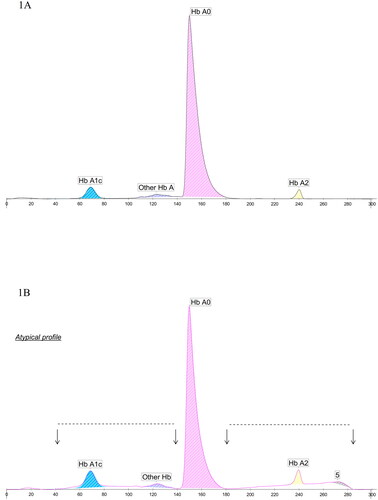 Figure 1. HbA1c electropherograms of (A) non-variant and (B) heterozygous Hb Tacoma. In (B) two very flat peaks (points 40–140 and 180–280, marked by arrows) below the normal peaks are observed and a peak characteristic of degraded hemoglobin (marked 5). HbA2 percentage is 3.4% (colored area).