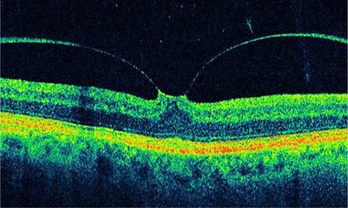 Figure 22 Optical coherence tomography typically shows an incomplete V-shaped posterior vitreous detachment temporally and nasally to the fovea that remains attached to the posterior vitreous.