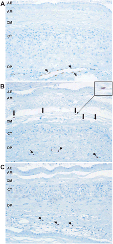 Figure 3.  IL-33 expression in pathologic pregnancies. (A) IL-33 is expressed in the nuclei of endothelial cells of decidual blood vessels in patients with preterm labor. IL-33 is not expressed in the mesodermal layer of the amnion. ×200 magnification. (B) IL-33 is expressed in the nuclei of macrophages in the chorioamniotic membranes of patients with preterm labor and acute chorioamnionitis. ×200 magnification. (C) IL-33 is not expressed in macrophages in the chorioamnionic membranes of patients with preterm labor and chronic chorioamnionitis. ×200 magnification. Short arrows indicate endothelial cells and thick arrows indicate macrophages. AE = amnion epithelium; AM = amnion mesoderm; CM = chorionic mesoderm; CT = chorionic trophoblast layer; DP = decidua parietalis.