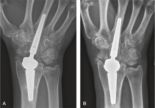 Figure 38. A) At 4 years, well integrated arthroplasty and well-functioning wrist. B) At 5.5 years, loosening of both components with enveloping double lines, subsidence and compensatory metacarpal diaphyseal widening.