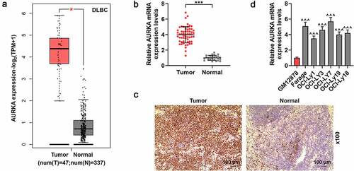 Figure 1. AURKA presented a high expression in DLBCL tissues and cells. (a) The expression of AURKA in the DLBC tumor tissues from DLBC patients than that in normal lymphoid tissues from healthy people was analyzed by GEPIA2 (http://gepia2.cancer-pku.cn/#index). (b) The expression of AURKA in DLBCL tumor tissues from DLBCL patients and normal lymphoid tissues from healthy volunteers was detected using qRT-PCR, and the GAPDH was the internal control. (c) The expression of AURKA in DLBCL tumor tissues from DLBCL patients and normal lymphoid tissues from healthy volunteers was detected using immunohistochemistry (IHC) assay (magnification, ×100). (d) The expression of AURKA in DLBCL cells and normal B lymphocyte was detected using qRT-PCR, and the GAPDH was the internal control. All experiments were repeatedly performed over 3 times. Experimental data were expressed by mean ± standard deviation (SD). (*P < 0.05, ***P < 0.001; ^^^P < 0.001; * vs. normal group; ^ vs. GM12878 group) (AURKA: Aurora-kinase-A; DLBCL: diffuse large B-cell lymphoma; GEPIA2:gene expression profiling interactive analysis 2; qRT-PCR: quantitative real-time polymerase chain reaction)