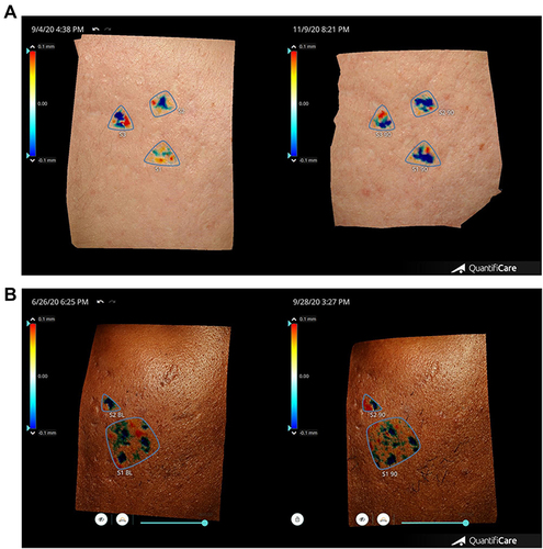 Figure 11 (A and B) 3D Micro Imaging demonstrating differences in improvement in scar depth in in subject with bland moisturizer (A) and patient treated with RSN (B). The deeper the blue the greater the depth.