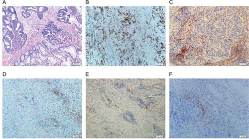 Figure 1 IHC staining of PD-L1 expressions in rectal cancer (magnification 200×).