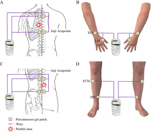 Figure 2 Schematic diagram of transcutaneous electrical acupoint stimulation (TEAS) operation.