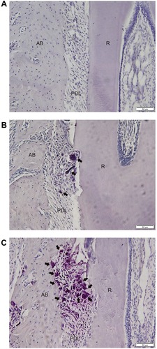 Figure 7 TRAP staining of the compression side of distopalatal root of maxillary first molar.