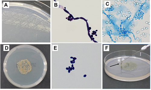 Figure 2 Colonies and stained fungal bodies of Exophiala dermatitidis from the bronchial lavage fluid of patient 1. Small colonies (A) and the filamentous and yeast-like fungi (B) were found by Gram staining at 24 hours later. The annelloconidia are clearly seen with lactophenol cotton-blue staining after 48 hours incubation of the small colonies at 24 hours with human leucocytes as the stimulator (C). Huge, dark colonies (D) and yeast-like form fungi (E) were found at 72 hours later, The colonies at 72 hours show high viscosity ((F), arrows).
