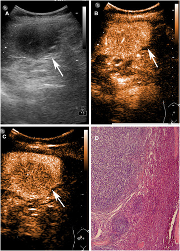 Figure 3 Splenic non-Hodgkin’s lymphoma in a 41-year-old female patient. (A) B-mode US shows a normal-sized spleen with a 4.2 cm in diameter inhomogeneous hypoechoic lesion (arrow). (B) CEUS shows heterogeneously iso/hyperenhanced lesion (arrow) with irregular vessels in arterial phase (15 seconds after contrast injection). (C) CEUS shows the enhancement (arrow) in parenchymal phase was lower than that in normal spleen in parenchymal phase (3 minutes after contrast injection). (D) Photograph of corresponding pathologic specimen through hematoxylin-eosin staining (40 magnification).