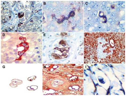 Figure 7 Immunostain demonstrated exclusion factor positional identity in relation to enolase immunopositivity expression of embryoid body and HCG immunopositivity exclusion factor identity expression in surrounding tissues; this means that in labeled tissues the expression of enolase is limited to the structure and excludes the surrounding tissue, just as the expression of HCG was negative to the structure and positive for the surrounding zone. Exclusion factor embryoid body enolase immunopositivity. (A) Case of lung carcinoma, (B and C) Case of liposarcoma, (D) Renal cell cancer, (E) Prostate adenocarcinoma, (F) Exclusion factor surrounding tissue H CG immunopositivity, case of lung carcinoma. Compare image (E) with (F). (G) Detachment subimage of (H) Showing HCG immunopositivity of surrounding tissue and, embryoid bodies are negative in a case of trophoblastic testicular tumor. (I) HCG spot immunopositivity of surrounding tissue with immunonegativity of embryoid body in a case of liposarcoma.Abbreviation: HCG, human chorionic gonadotropin.