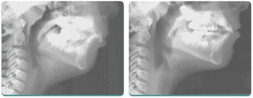 Figure 1 The patient illustrated above presented with a Class II Division 1 malocclusion and was treated with Orthotropics® to advance the maxillary anterior teeth, followed by advancement of the mandible. The airway improved dramatically in her case as both jaws were developed forward.