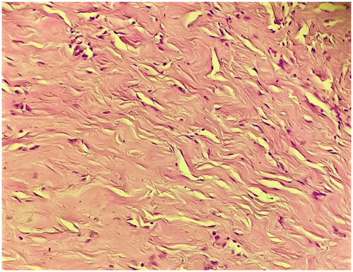 Figure 2. High power view showing pseudoangiomatous stromal hyperplasia, with multiple slit-like spaces often displaying myofibroblasts at their margins that simulate endothelial cells (40× Magnification; Hematoxylin-Eosin staining).