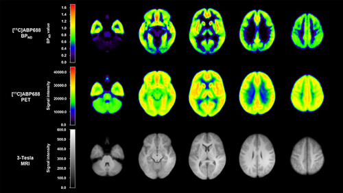 Figure 1 Representative mean images of [11C]ABP688 BPND, PET, and 3-Tesla MRI for 18 healthy controls. The [11C]ABP688 PET image is generated by averaging the reconstructed 21 frames of dynamic image.