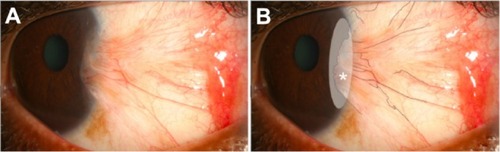 Figure 1 (A) Slit lamp photograph of a patient before subconjunctival injection. (B) Area of neovascularization (asterisk) was outlined with the software.