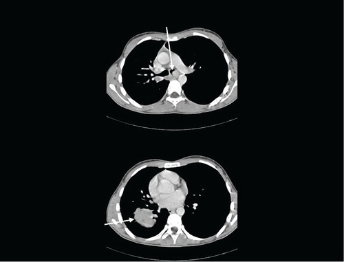 Fig. 1 Contrast-enhanced chest CT at diagnosis. Arrows show tumour mass in left main bronchus (upper image) and in right lower lobe (lower image).