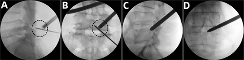 Figure 2 Intraoperative fluoroscopic views. (A and B) The target point of UBE (Black circle: The junction of the spinous process and the inferior lamina of the left L5). (C and D) The drill of the PTED.