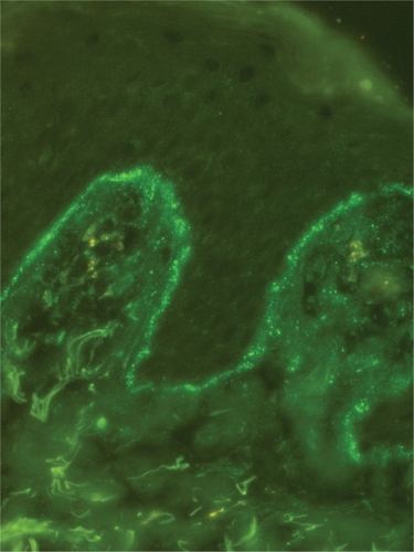 Figure 6 Granular (lumpy) pattern of complement component 3 deposits in sun-protected nonlesional skin in patient with systemic lupus erythematosus (original magnification:×400).
