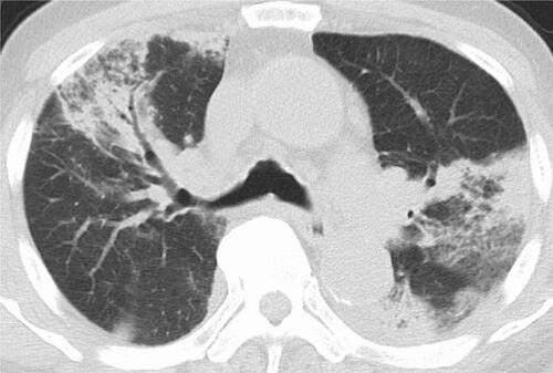 Figure 3 Chest CT with the lung window setting shows infiltrations in bilateral lung fields.