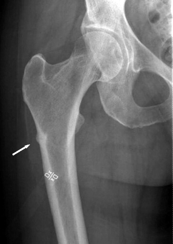 Figure 1. Right femur. Arrow indicates undisplaced fatigue fracture.
