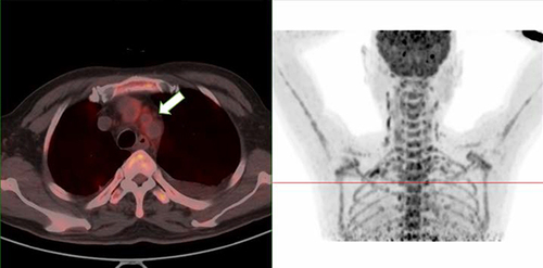 Figure 1 PET/CT showing FDG metabolism is mildly increased with uneven distribution in the walls of the right head and arm, left common carotid artery, and the starting segment of the left subclavian artery.