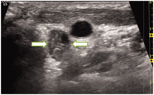 Figure 1. A 22-year-old male patient with PTC was found to have metastatic lymph nodes in area VI of the right neck (Ultrasound image obtained from head side of patients). The lymph node was located between the common carotid artery and the trachea. The size of lymph nodes was about 1.2cmx1.2 cm.