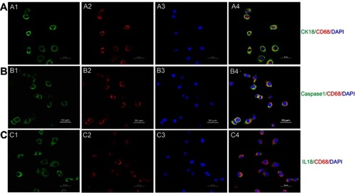 Figure S1 Transdifferentiation of proximal tubular epithelial cell to macrophage in a high glucose environment. (A) Costaining of PTC immunolabeled by cytokeratin (CK)-18 and macrophage immunolabelled by CD68. Green: cytokeratin (CK)-18; Red: CD68; Blue: DAPI; Merge is CK18 with CD68. (B) Costaining of pyroptosis signaling immunolabeled by caspase-1 and macrophage immunolabeled by CD68. Green: Caspase-1; Red: CD68; Blue: DAPI; Merge is caspase-1 with CD68. (C) Costaining of pyroptosis signaling immunolabeled by IL18 and macrophage immunolabeled by CD68Green: IL-18; Red: CD68; Blue: DAPI; Merge is IL-18 with CD68. Original magnification =400x. Bar width =50 μm.