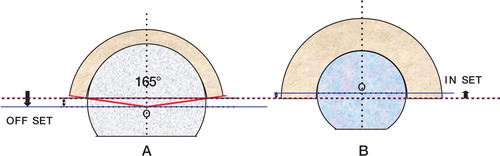 Figure 3. The femoral head offset is the distance from the center of the head (O) to the opening plane of the cup (purple line). If the head center is outside the cup, the offset is positive (A); otherwise it is negative and is called inset (B). The use of large heads above 38 mm in diameter generally imposes the use of an offset because the cup is usually a truncated hemisphere of 165° for the large heads.