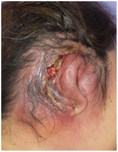 Figure 1. The first visit. Redness, swelling, necrosis, and pus in the right ear.