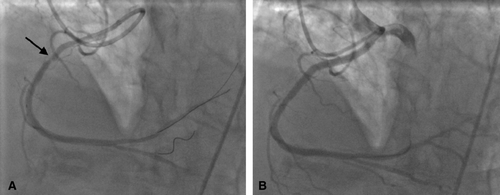 Figure 1.  (A) Anomalous RCA from left sinus of Valsalva pre-PCI in LAO projection with 3DRCA guide and three wires required to visualize lesion (arrowed). (B) Post-PCI of RCA in LAO projection.