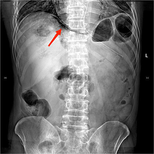 Figure 6 Plain film of the abdomen. There is a crescent-shaped free gas formation under the diaphragm (marked with a red arrow).