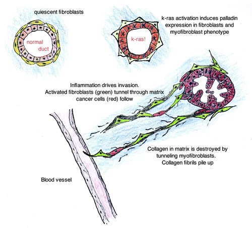 Figure 4. Stromal fibroblasts in normal pancreas are quiescent and without palladin staining. K-ras activation in ductal cells leads to paracrine signaling that is sufficient to induce palladin-associated myofibroblast transformation of the adjacent fibroblasts. This event occurs early in tumorigenesis, when epithelial cells are dysplastic, and increases with neoplastic progression. In the setting of a wounding signal, the palladin-activated fibroblasts develop cellular protrusions (feet) that express invadopodia proteins, proteases and enhance the capacity for invasion. The palladin-activated fibroblasts create tunnels through the matrix, assisting the escape of cancer cells into the neo-vasculature. The activated fibroblasts appear to accompany the cancer cells to their metastatic niche in breast and pancreatic cancer models.