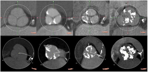 Figure 1. Evaluation of aortic valve calcification with computed tomography