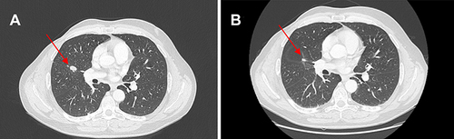 Figure 1 (A) Red arrows show lung metastases at baseline and (B) after 12 weeks of therapy with ribociclib.