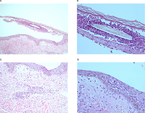 Figure 2 (A and B) Pemphigus foliaceous. The subcorneal separation containing a hair fragment surrounded by many neutrophils, mild eosinophils, and some acantholytic cells (H&E, 40x and 400x, respectively). (C) Pemphigus foliaceous. Mild superficial perivascular and interstitial infiltrations by lymphocytes with mild eosinophils (H&E, 200x). (D) Pemphigus foliaceous. Mild spongiosis, few intraepidermal eosinophils and little basal vacuolization (H&E, 400x).