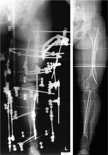 Figure 4. Gradual deformity correction after a single osteotomy at the distal femur and the proximal tibia with external fixator (left). Secondary late intramedullary nailing after a deformity correction (right).