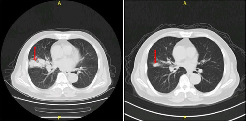 Figure 3 The CT scan results of the changes for primary target lesions in one patient with SCLC after 2 cycles of treatment with anlotinib.