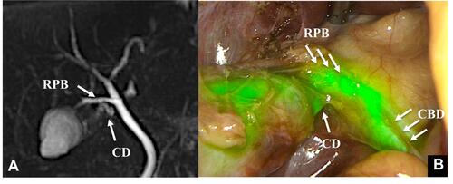 Figure 2 Case 2 MRCP shows the independent right posterior branch (RPB) entering the common hepatic duct (CBD), and the cystic duct (CD) branches off of the independent right posterior branch (A). The CD was confirmed by fluorescence after the direct injection of ICG into the gallbladder (B).