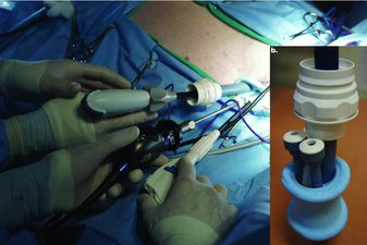 Figure 1. a. Intraoperative image of a tiger undergoing SILS™ port ovariectomy. The Ligasure Atlas™ and 10 mm inner cannula are to the left, the 5 mm telescope and camera are in the middle cannula, and the 5 mm Endo Grasp™ is to the right. b. Image of the SILS™ port with one 10 mm and two 5 mm inner cannulas.