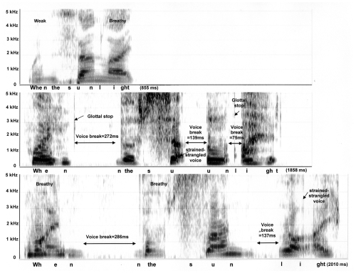 Figure 2 Spectrograms of the phrase “When the sunlight …” spoken by a 74 year old female: normal control subject is depicted on the top panel, ADSD before BT injection is on the middle, and ADSD after BT injection is on the bottom panel.
