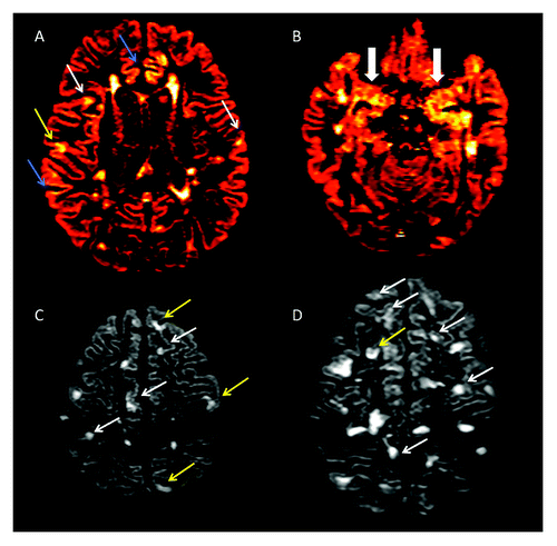 Figure 1. (A-D) Axial double inversion recovery from four patients suffering from Relapsing-Remitting Multiple Sclerosis. Several type II (white arrows), Type III (blue arrows) and Type IV (yellow arrows) are detectable (A), some of which involving the Hippocampus (B). Two patients (C and D), having a very high cortical lesion load, suffer also from epilepsy and from a significant cognitive dysfunction.